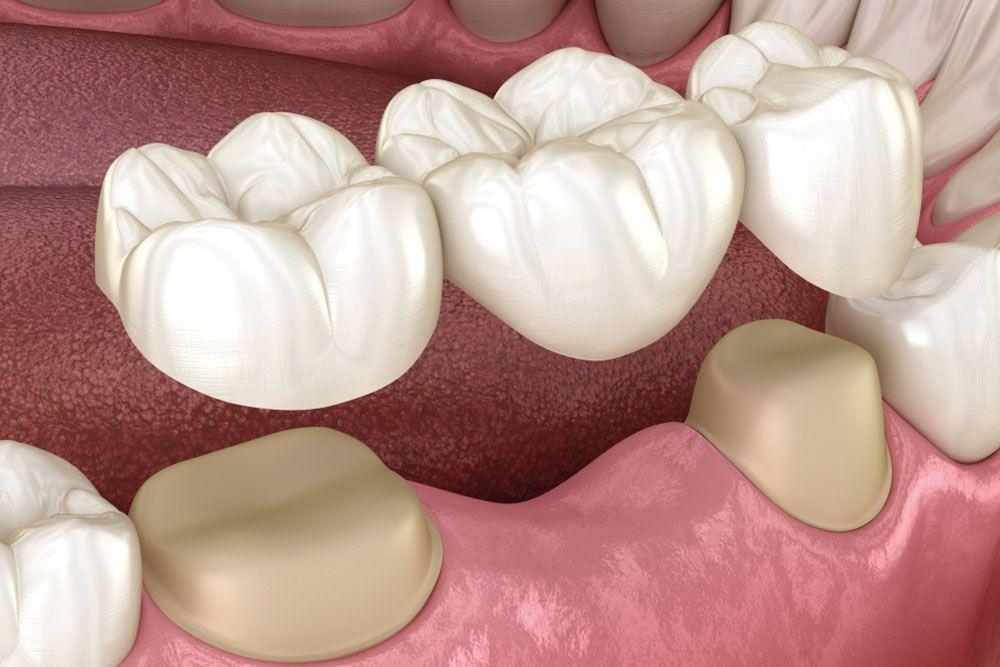 Dental Bridges 1260385081.jpg.optimal