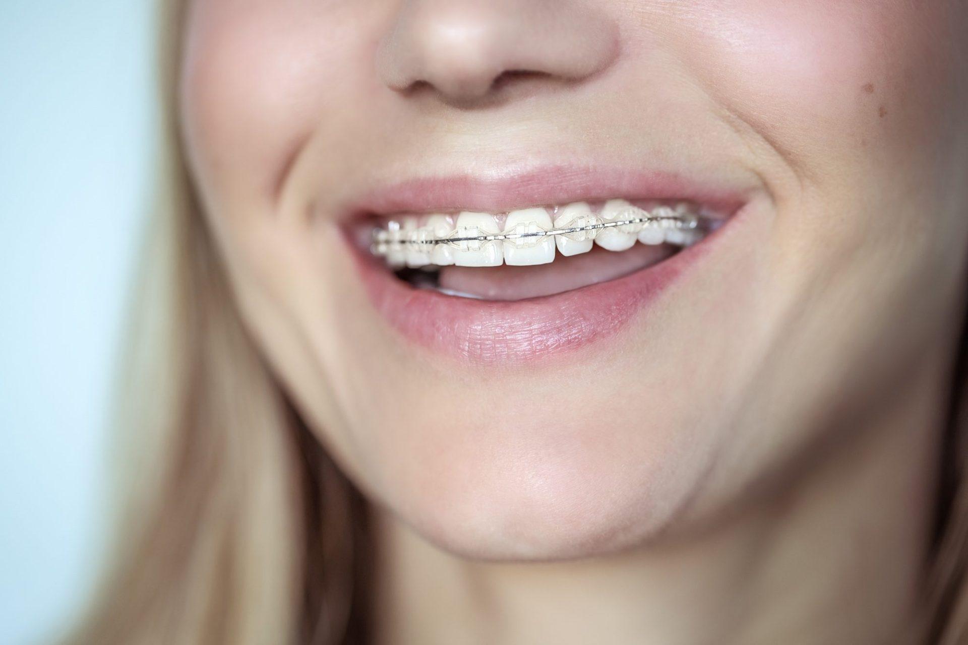 braces treatment for a crooked teeth