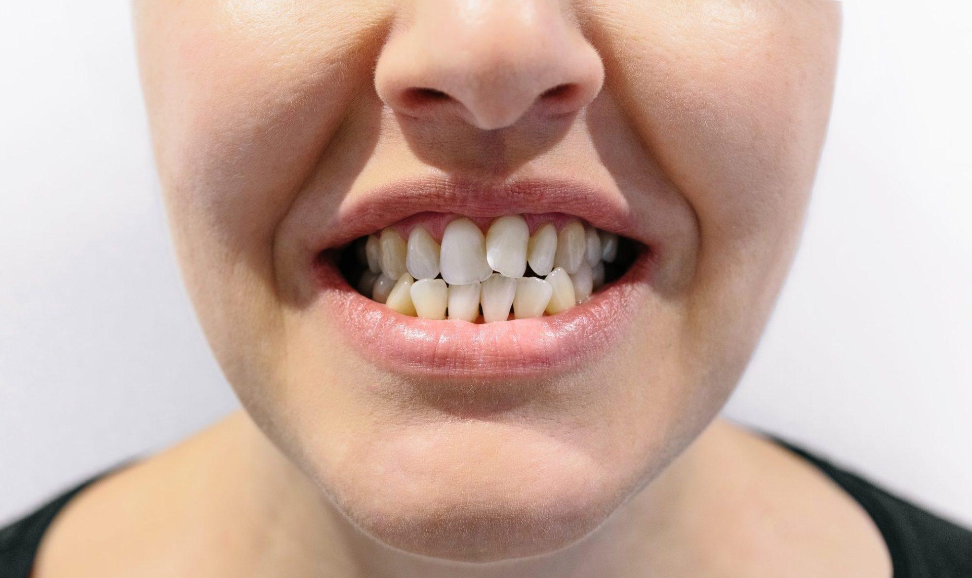 woman mouth with dental crowding