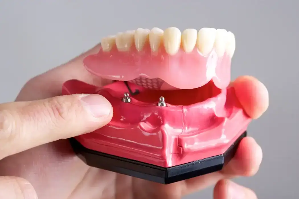 All On X 31 Cost of Full Mouth Implants in West Ryde