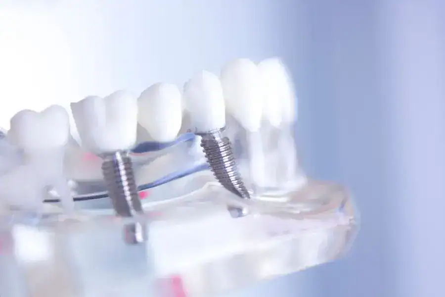 Our Step-by-Step Dental Implant Process