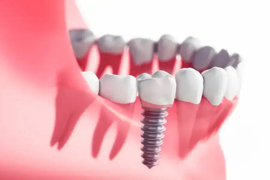 Single Tooth Implants