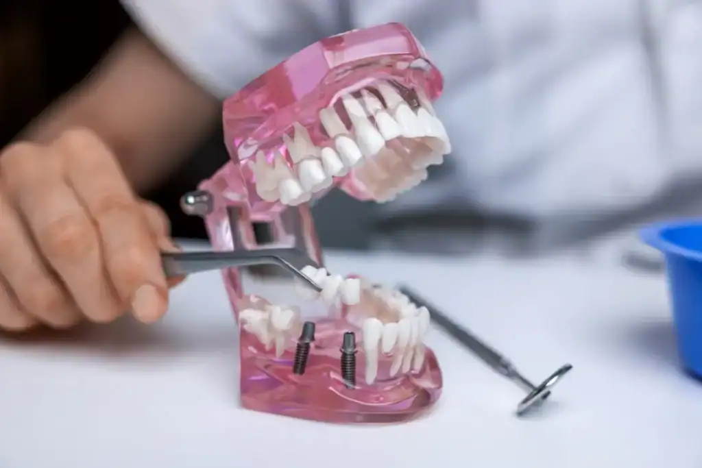 All On X 27 What Are Full Mouth Implants