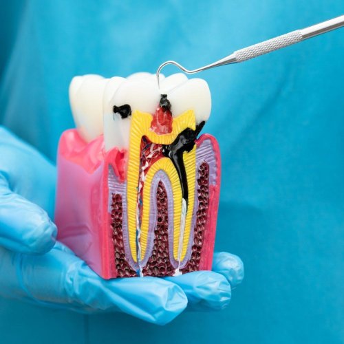 Root Canal Treatment