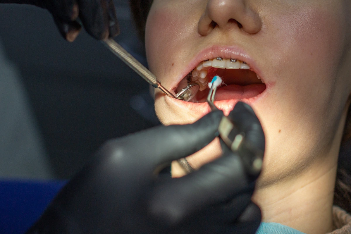 dental scaling in west ryde