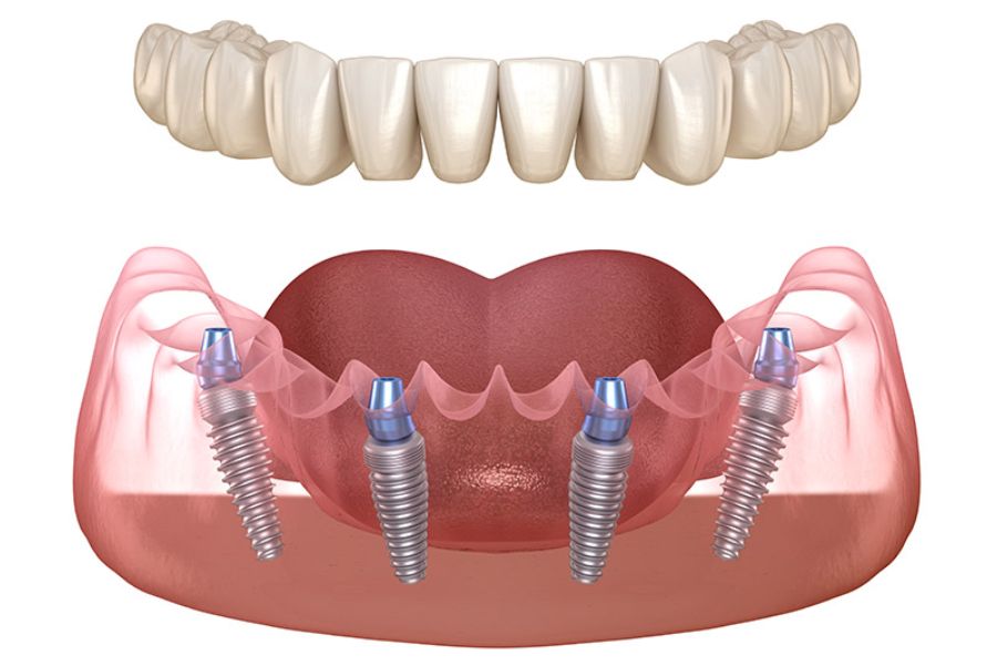 All-on-4® Dental Implants