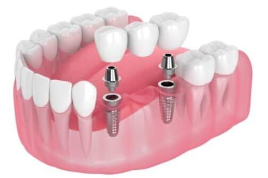 Multiple Teeth Implants
