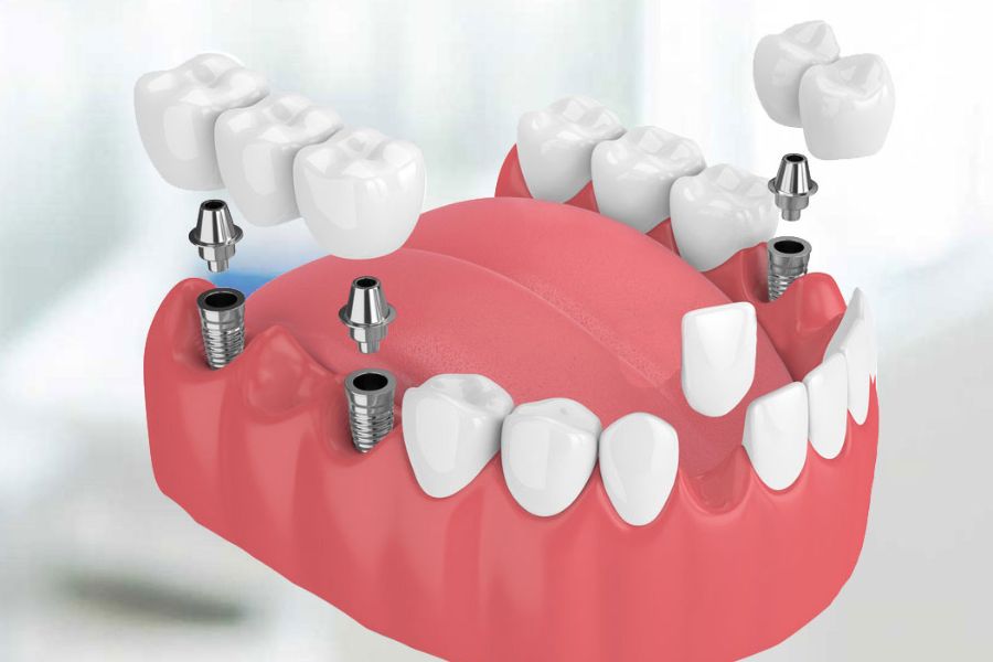Multiple Teeth Implants
