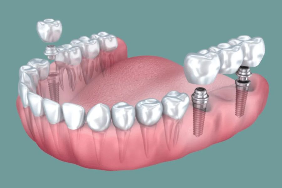 Multiple Teeth Implants