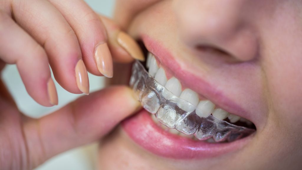 What Happens in a Clear Aligner Consultation