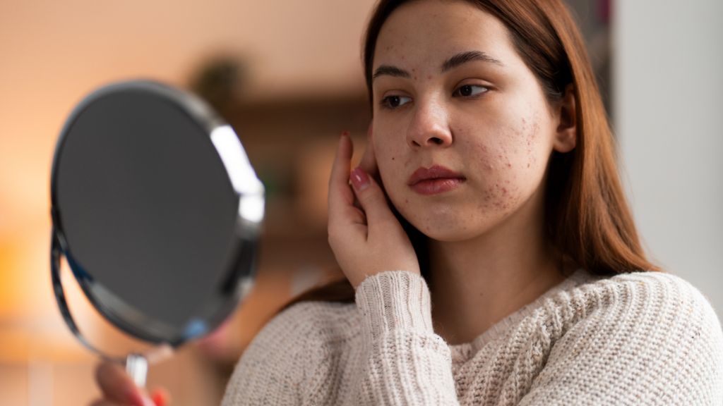 Why Do Some Acne Scars Need Professional Care