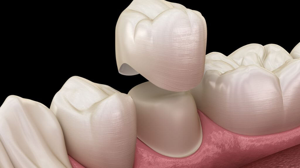 Dental Crown - Education