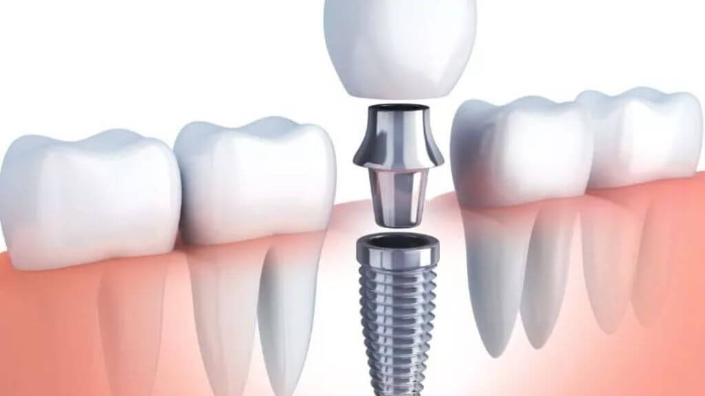 Dental Implant -