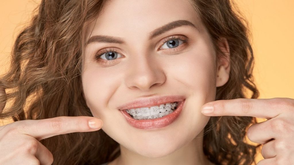 Ceramic Braces