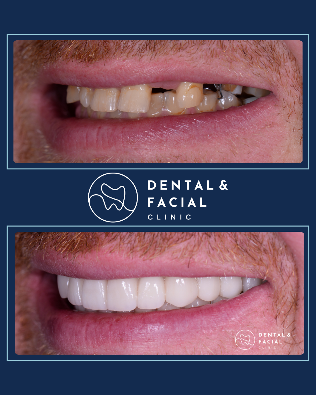 Snap-On Dentures 19 Treatment: VENEERS + IMPLANTS
Approximate Treatment Time: 5 months