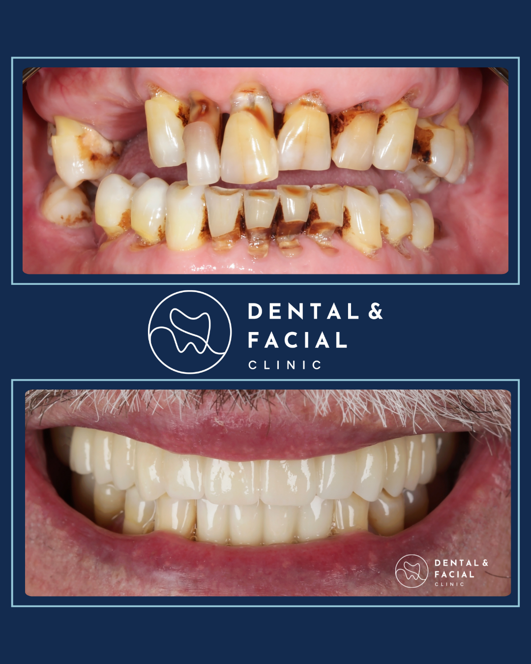 Snap-On Dentures 20 2