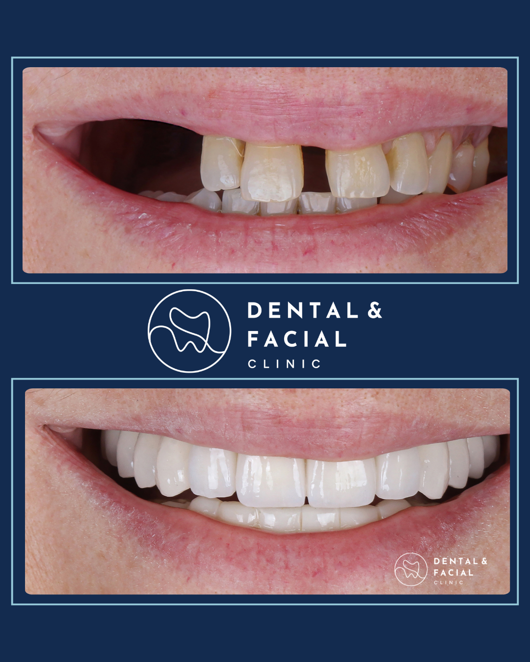 Snap-On Dentures 21 3