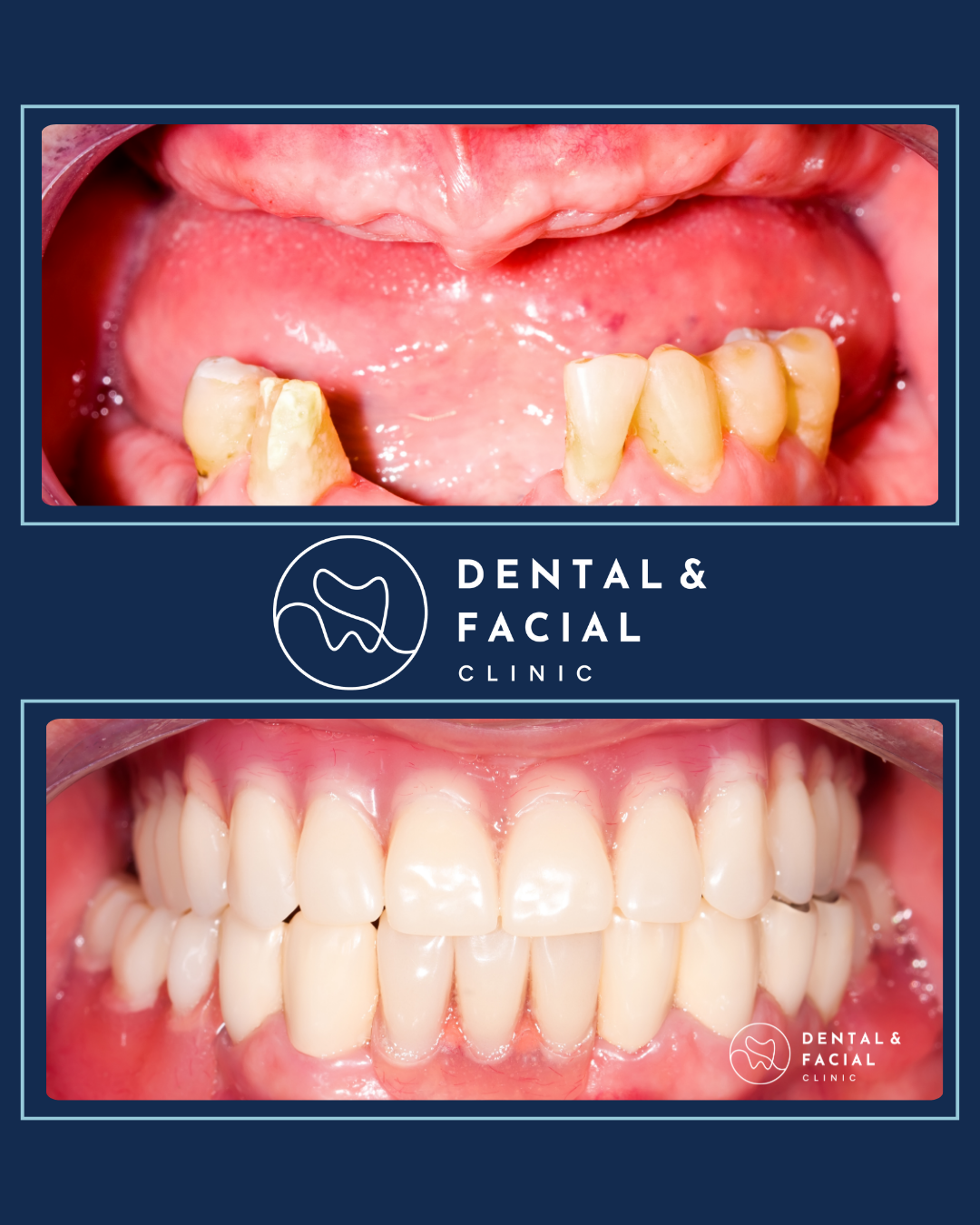Snap-On Dentures 22 4