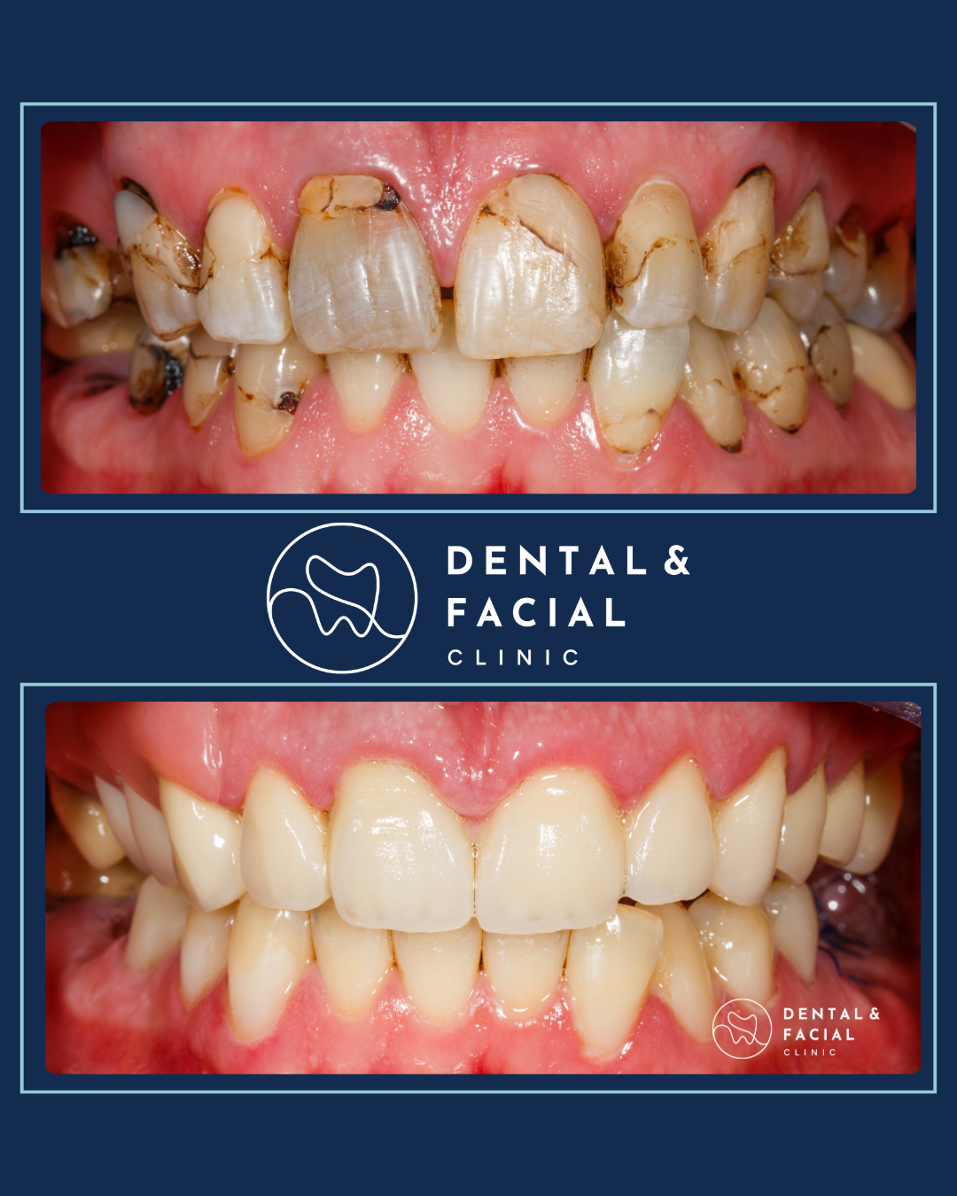 Snap-On Dentures 23 6