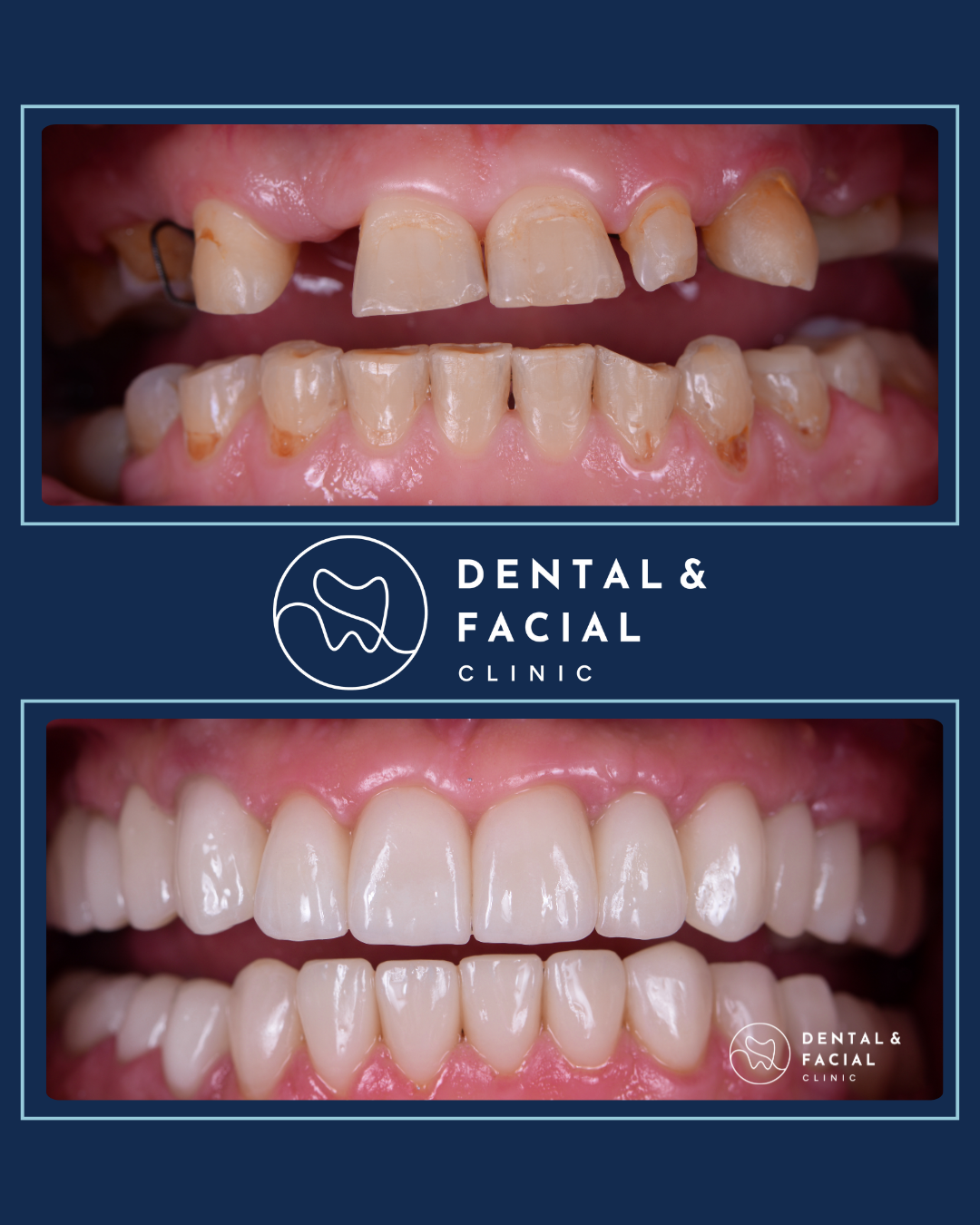 Snap-On Dentures 24 7
