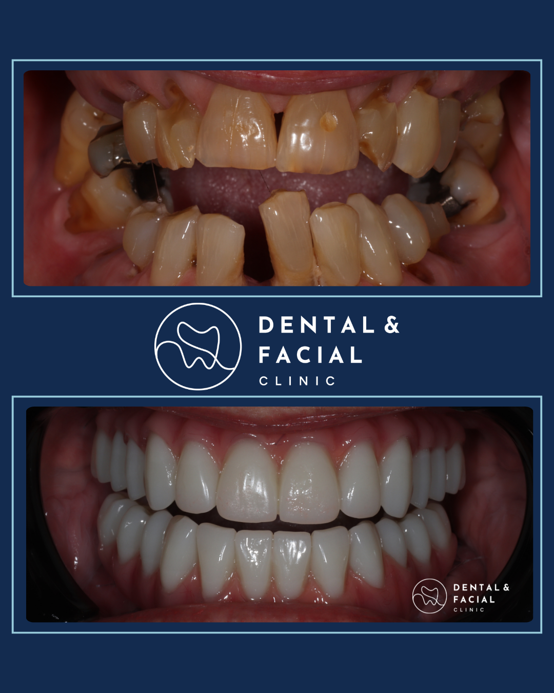 Snap-On Dentures 26 9
