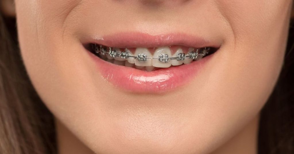 Braces
