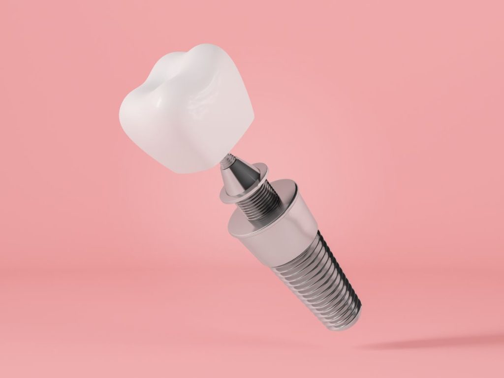 Dental Implants