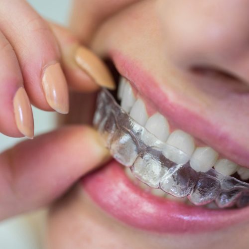 Invisalign® in West Ryde